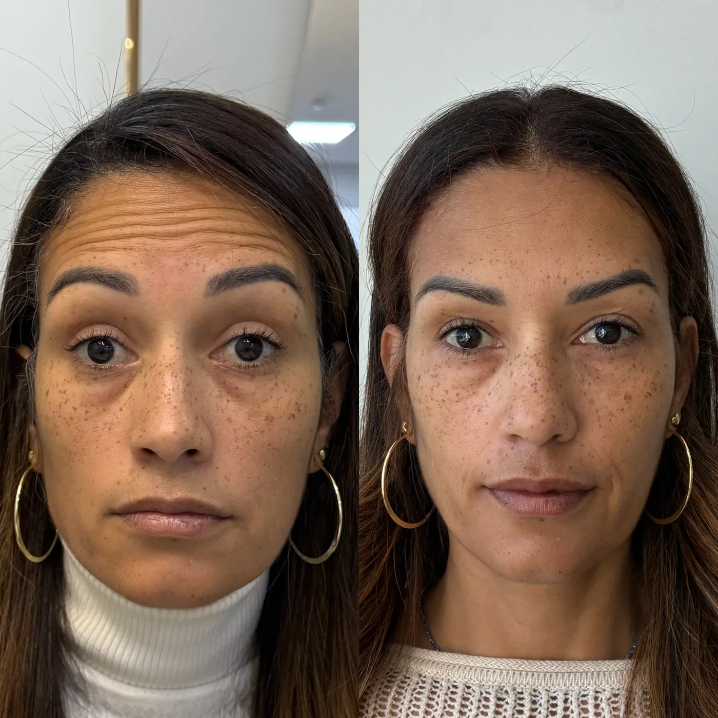 Harmonização Facial — antes e depois