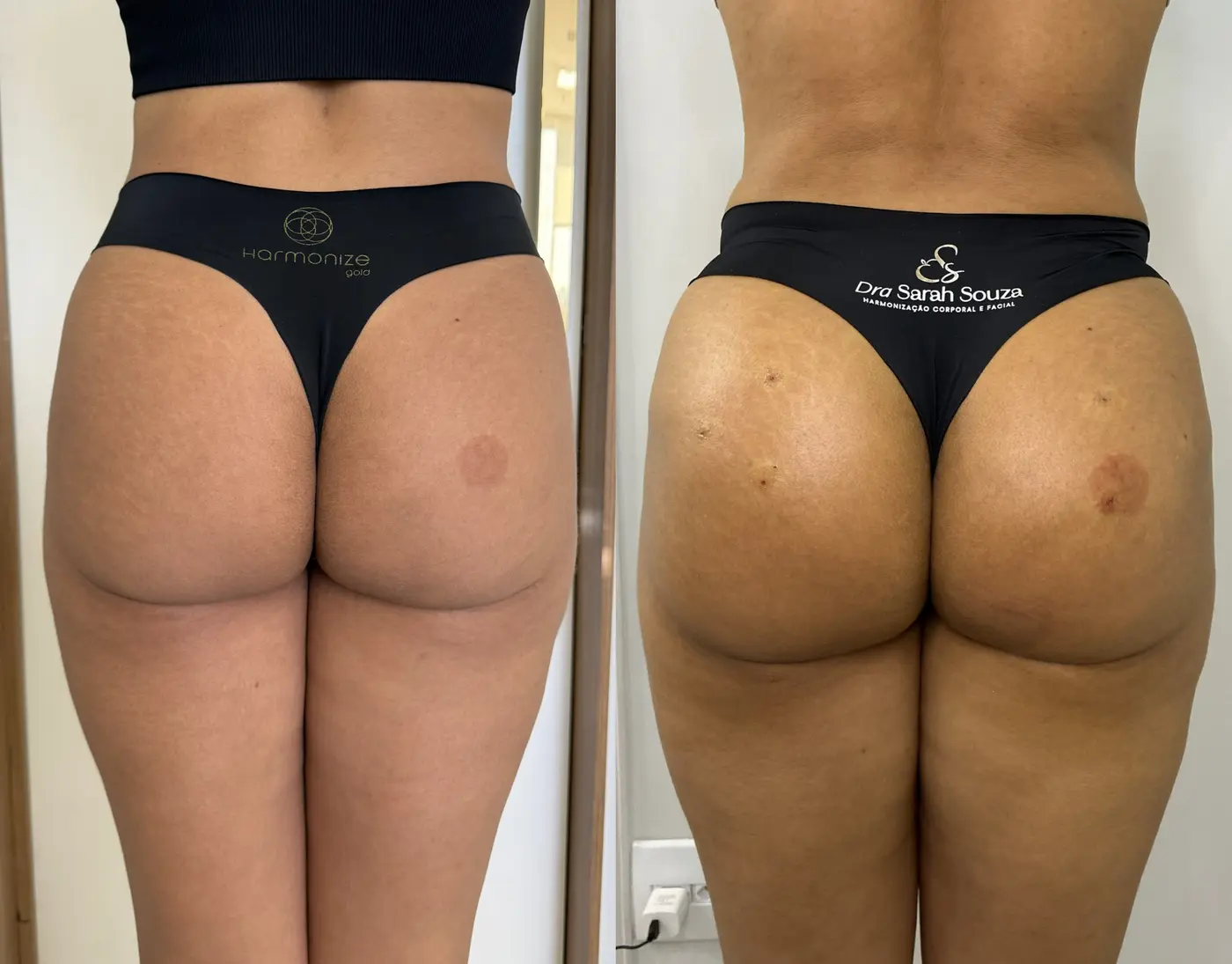 Harmonização Glútea — antes e depois